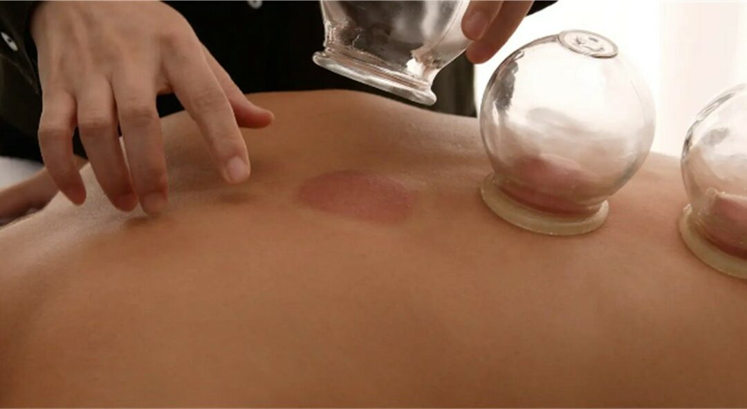 Cupping, la terapia antidolorifica che si applica alla pelle